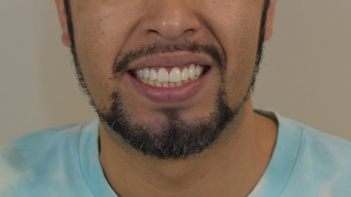 Diseño de sonrisa natural
