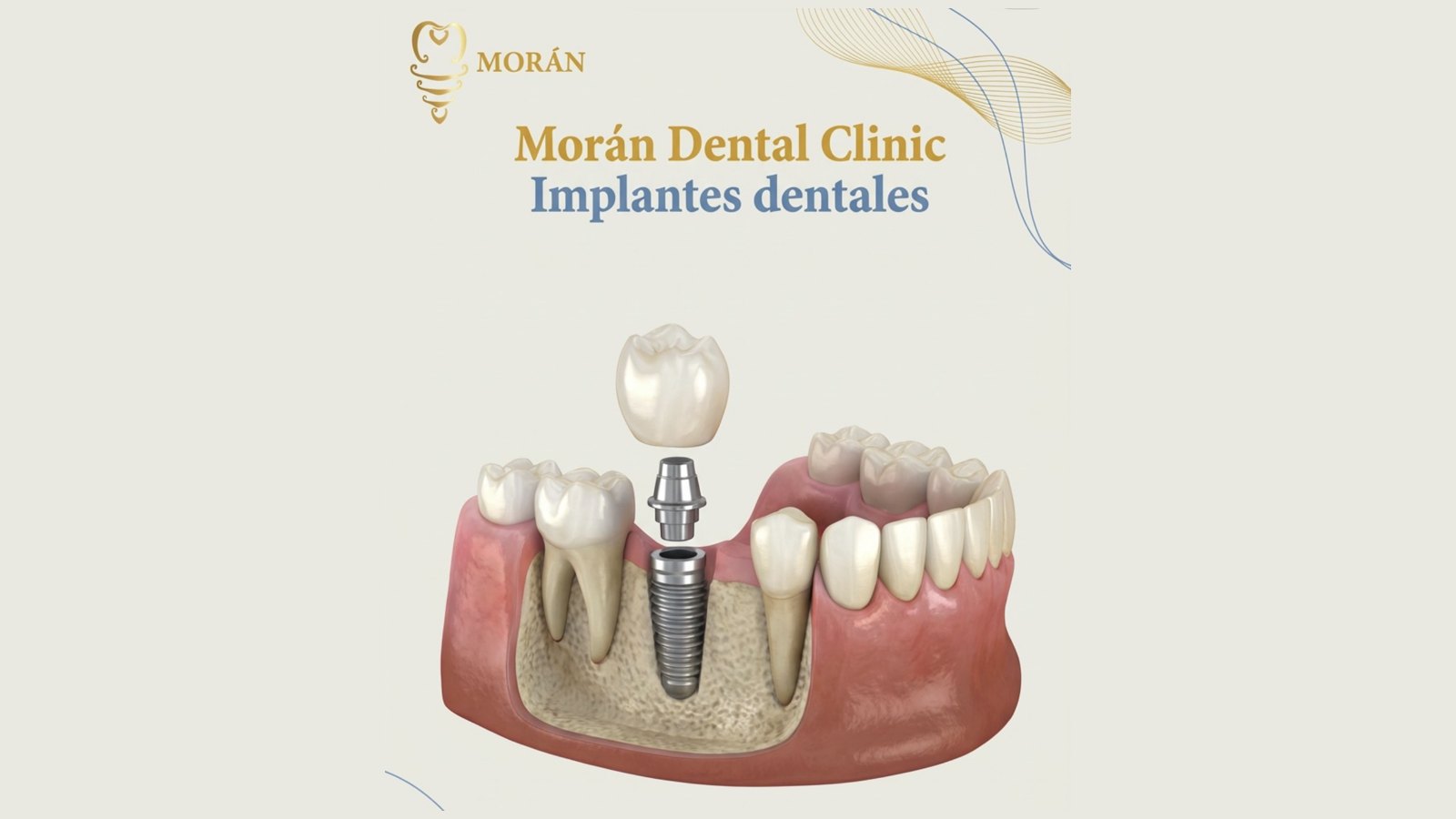 Implantes dentales: duración y cuidados